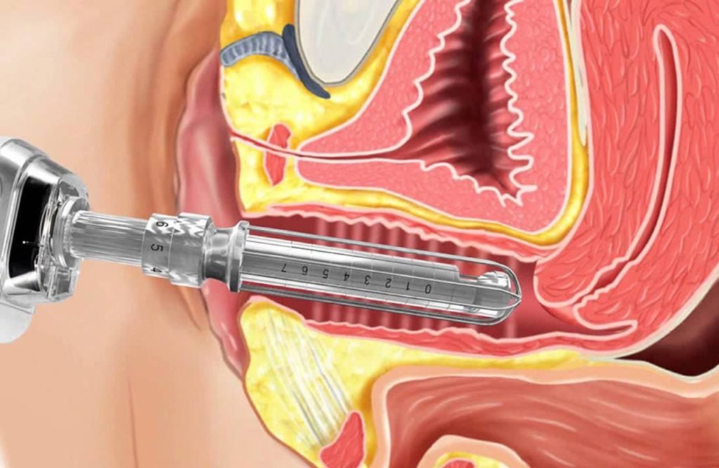 Laser vaginal como funciona