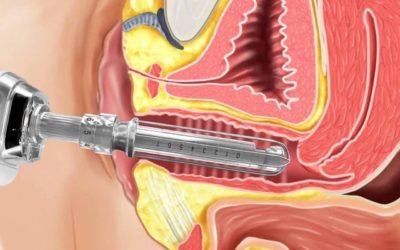 Laser vaginal: como funciona e para que serve