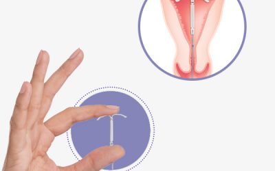 DIU Hormonal de Baixa Dose
