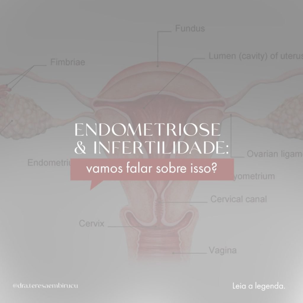 endometriose e a fertilidade